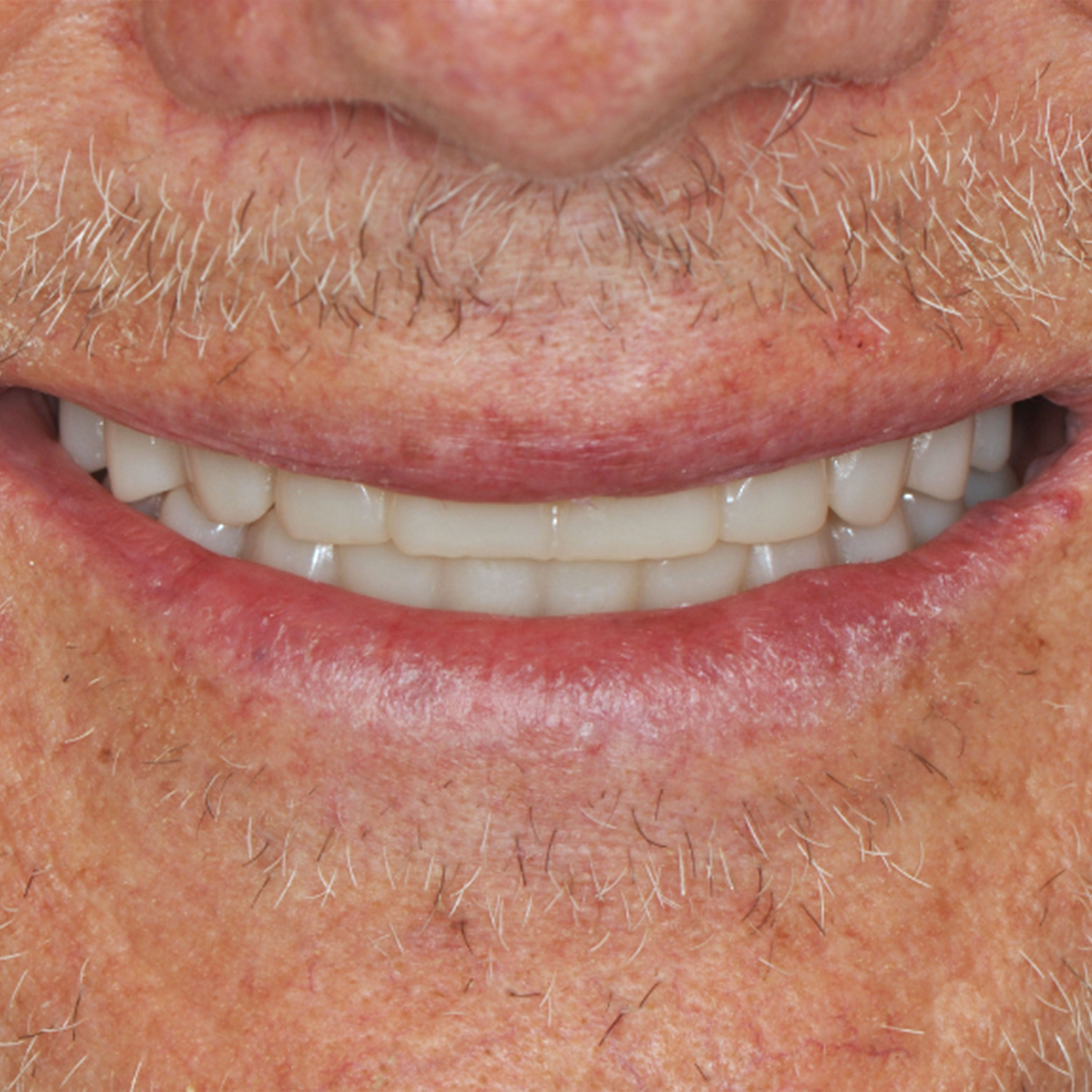 Full arch dental implants transformation - after