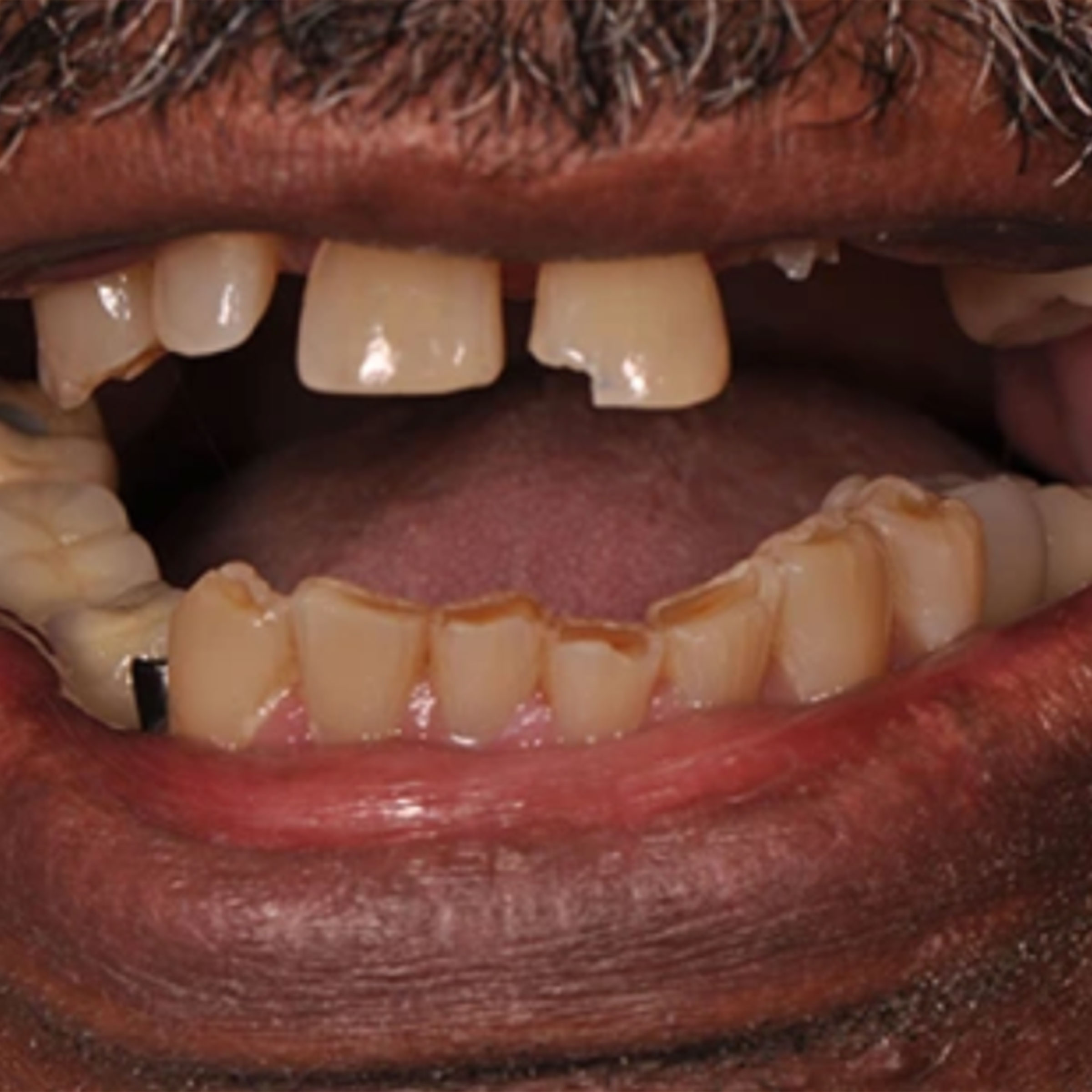 Full mouth dental implants transformation - before