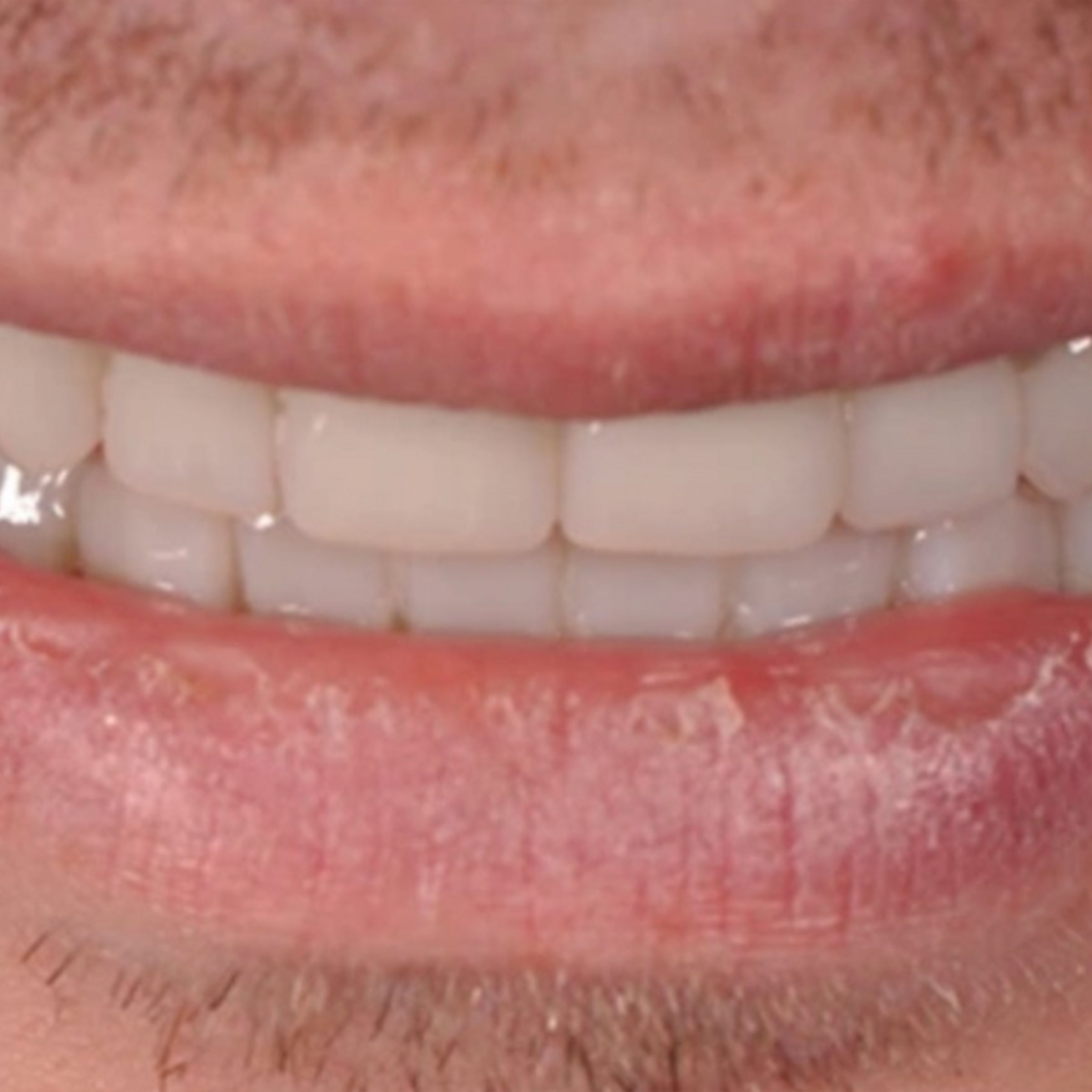 Full mouth dental implants transformation - after