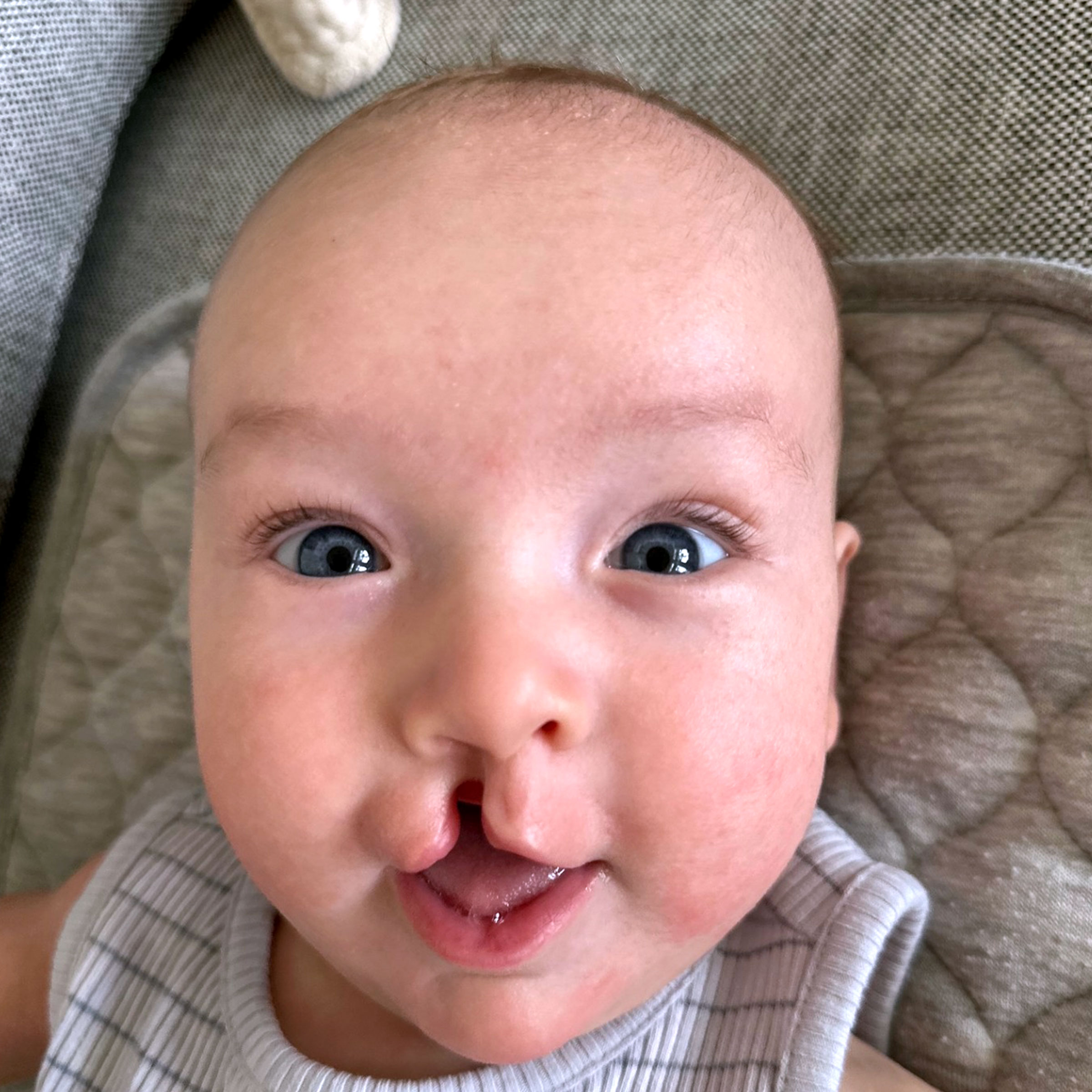 Cleft & Craniofacial Patient Transformation - Before