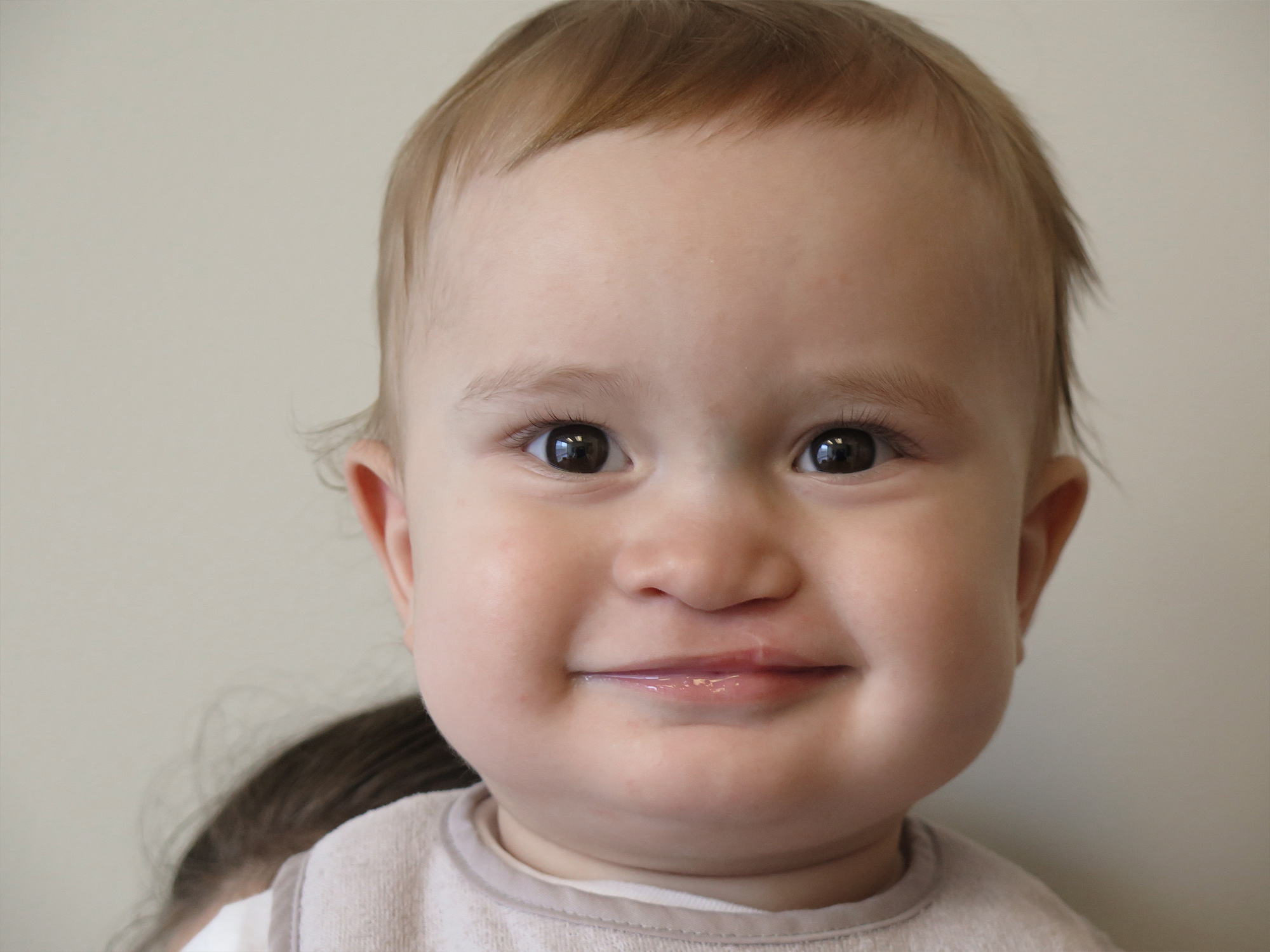 Cleft & Craniofacial Patient Transformation Journey