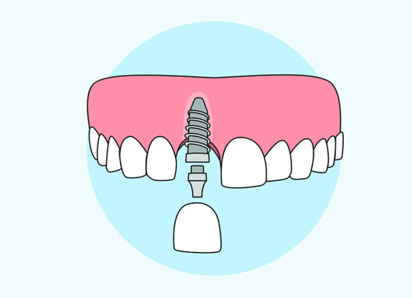 Dental Implant